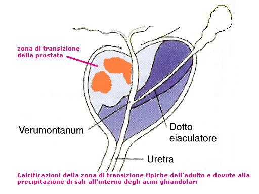 calcificazioni prostata giovani