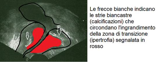 calcificazioni prostata dieta