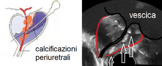 erezione calcificazione della prostata