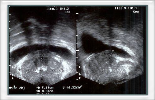 intervento calcificazione prostata alhasi puffadás nőknél