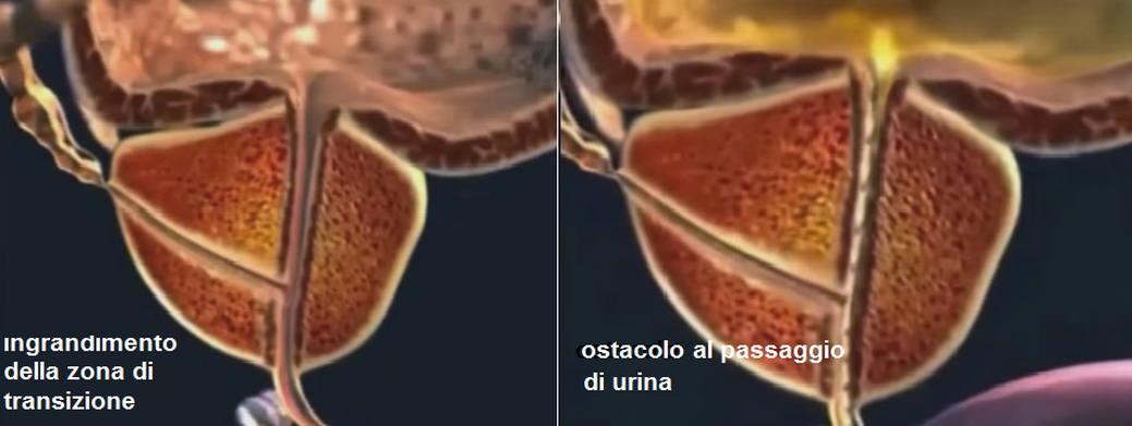 Hpv labbra sintomi