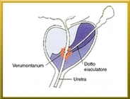 calcificazione prostatica del veru montanum