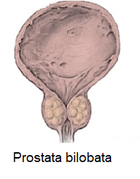 prostata bilobata ce doare cu prostatita in stanga