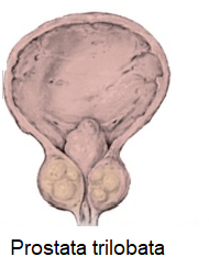 prostata ipertrofia del lobo medio Prostatitis olajbogyó