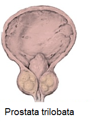 prostata ipertrofia del lobo medio