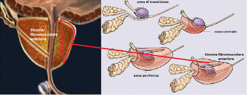 prostata ipertrofia del lobo medio)