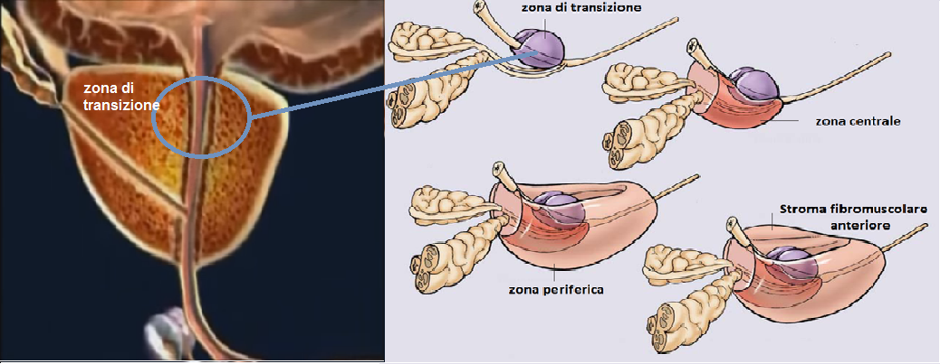 noduli adenomatosi alla prostata