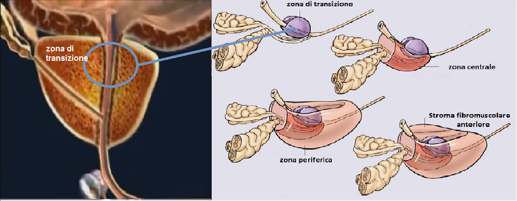 prostata adenomatosa bilobata